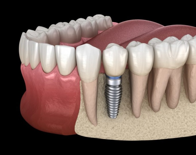 Dentista ad Alzate Brianza e implantologia a carico immediato? Ecco dove andare
