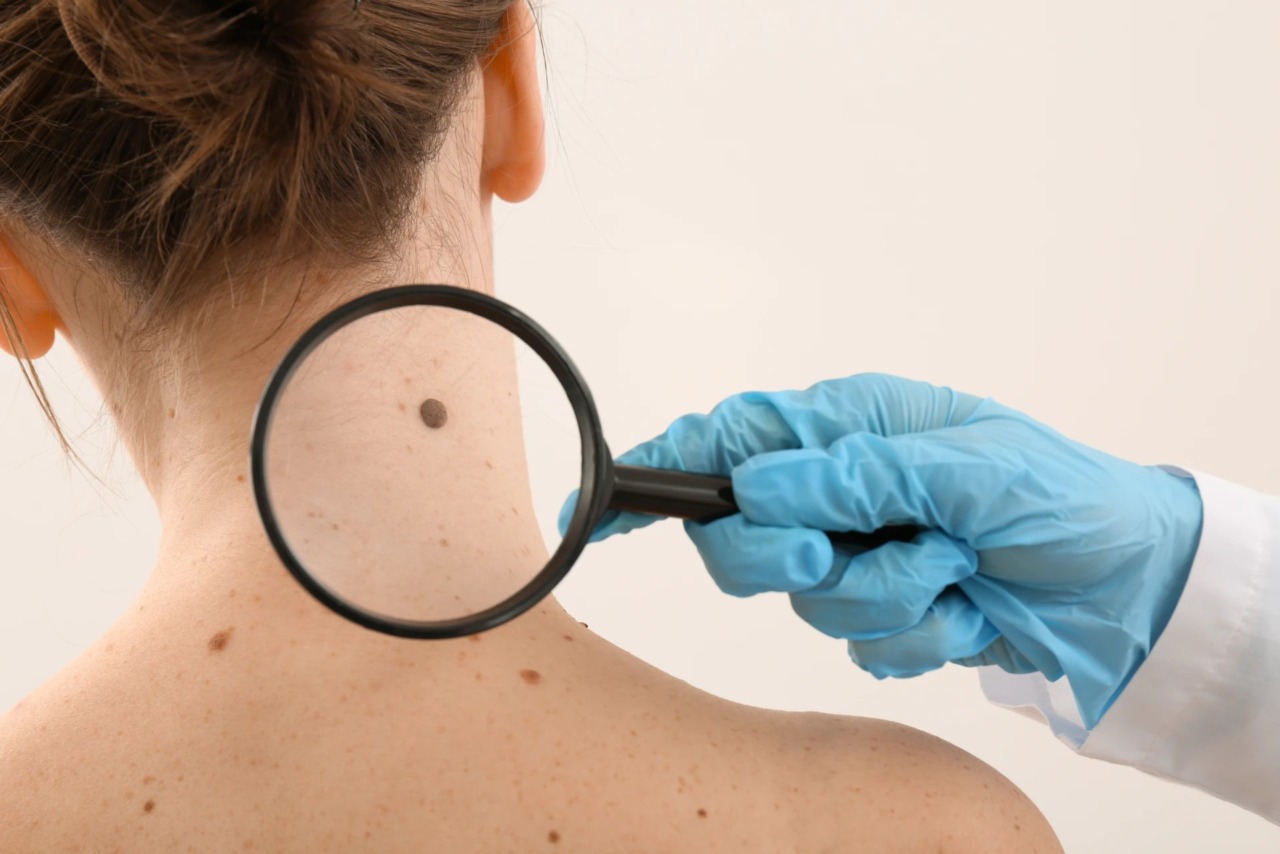 Melanoma della pelle: stiamo attenti al sole e ai nostri nei