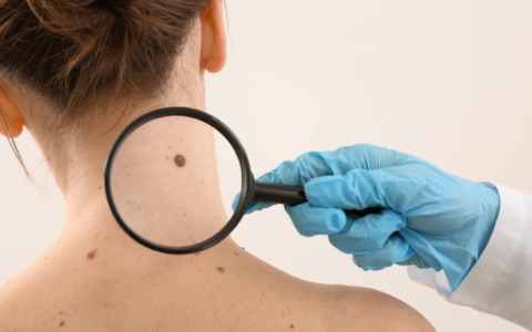 Melanoma della pelle: stiamo attenti al sole e ai nostri nei