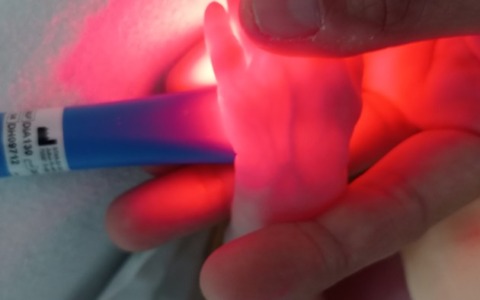 Nuovo strumento per la cura dei neonati prematuri