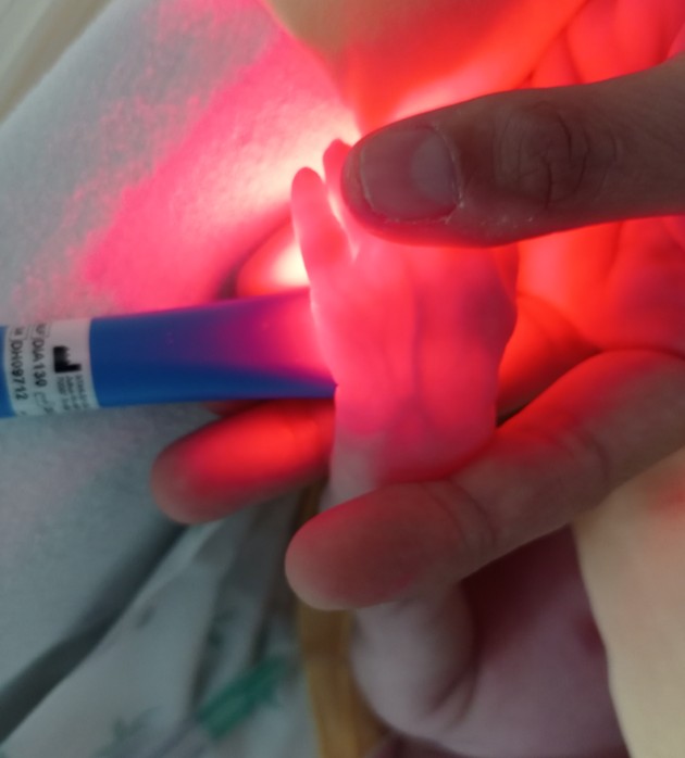 Nuovo strumento per la cura dei neonati prematuri