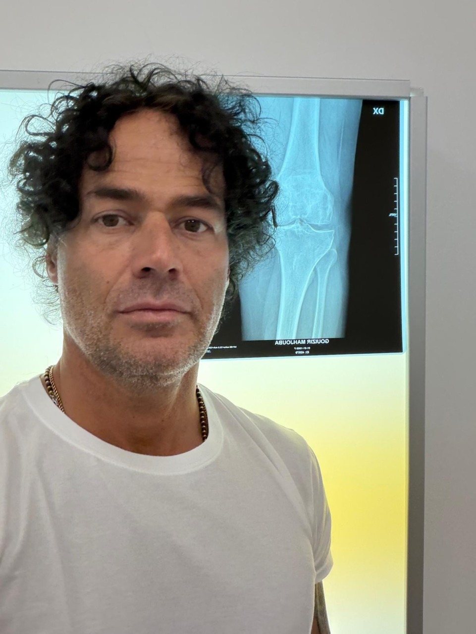 Protesi al ginocchio: al COF Lanzo Hospital debutta la tecnologia robotica ROSA